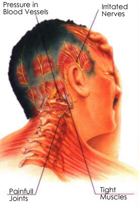 Headache osteopath